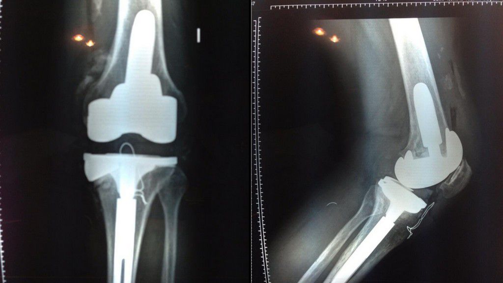 Radiografía de la rodilla de Ricardo Fort