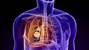 Cáncer de pulmón: conocer las características de cada tumor es clave